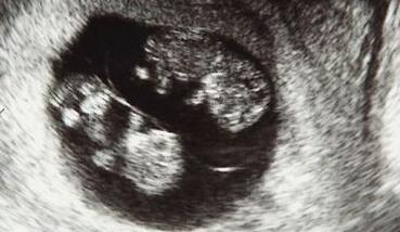 這三大方法 糾正胎位不正