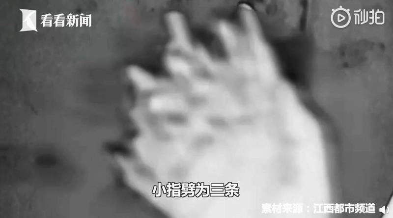 中國2歲男童右手捲入絞肉機 慘變「麵條手」