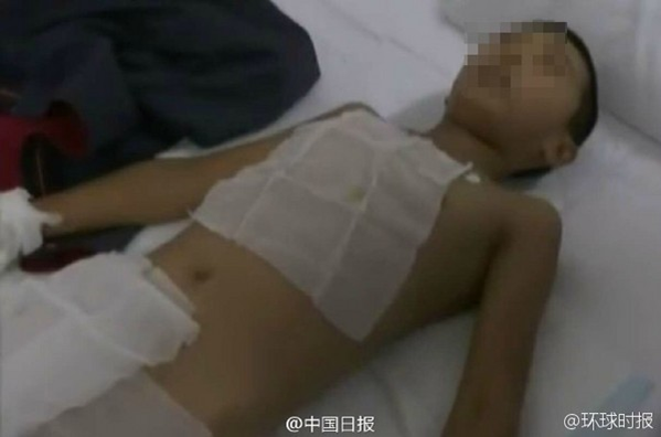 驚！充電時玩手機　男童被炸斷右手指_電腦割字